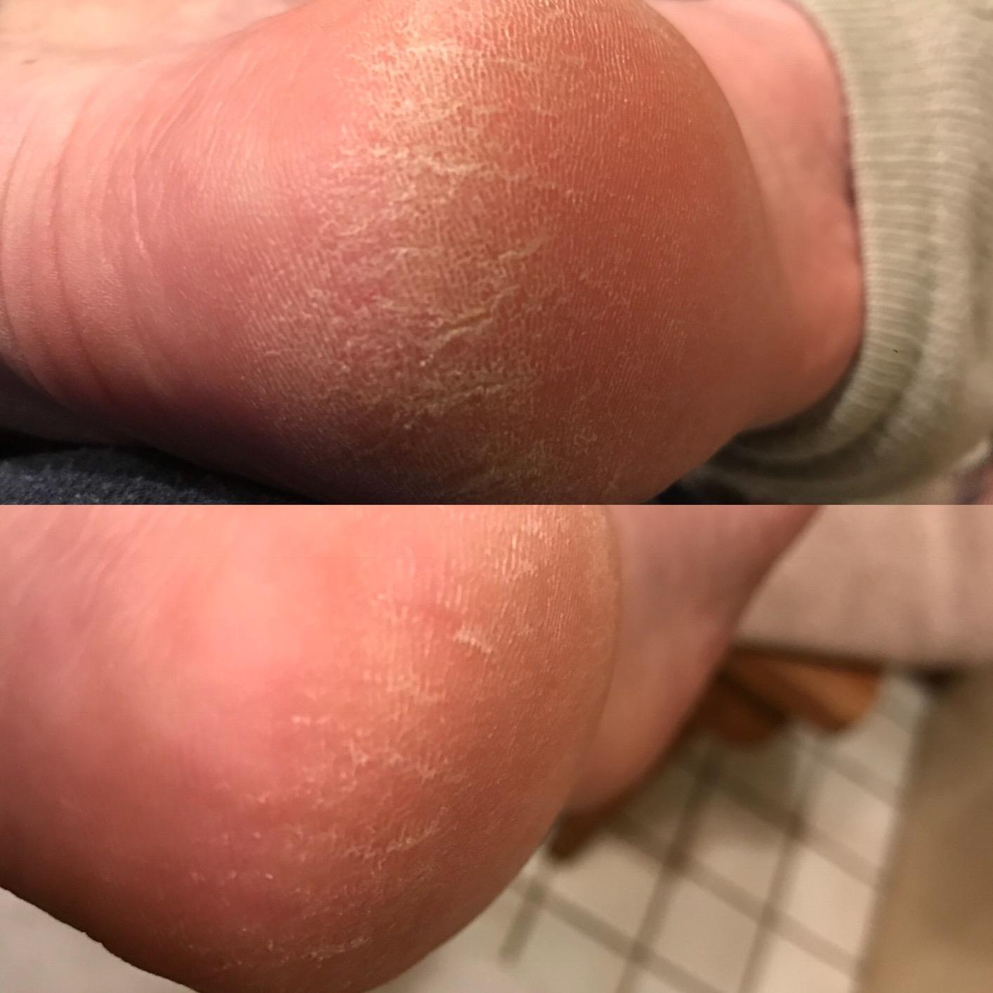 Flexitol Heel Balm 4 Oz Tube (Pack of 2), Rich Moisturizing & Exfoliating Foot Cream. Fast Relief of Rough, Dry & Cracked Skin on Heels/Feet. For Daily Use and Pedicures. Diabetic Safe and Effective customer photo 2