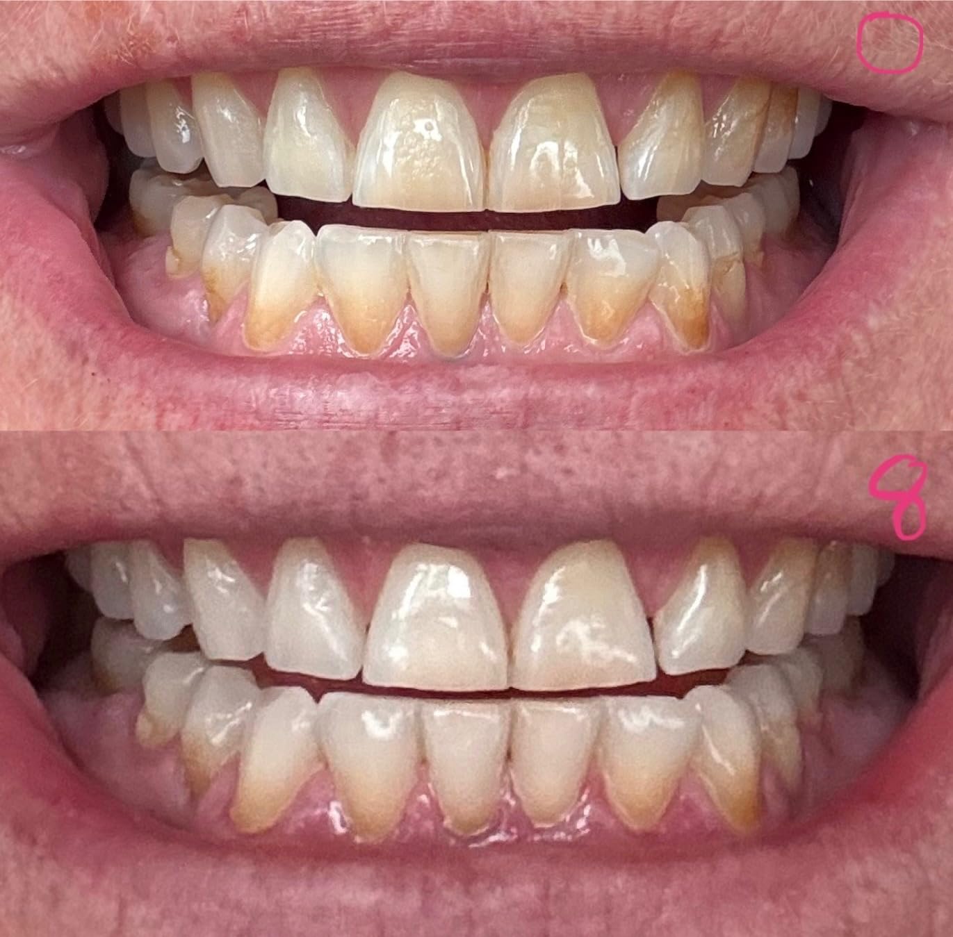 Auraglow 44% Teeth Whitening Gel for Trays, Retainers & Aligners - Dentist Strength Carbamide Peroxide Whitener, 30 Treatments customer photo 1