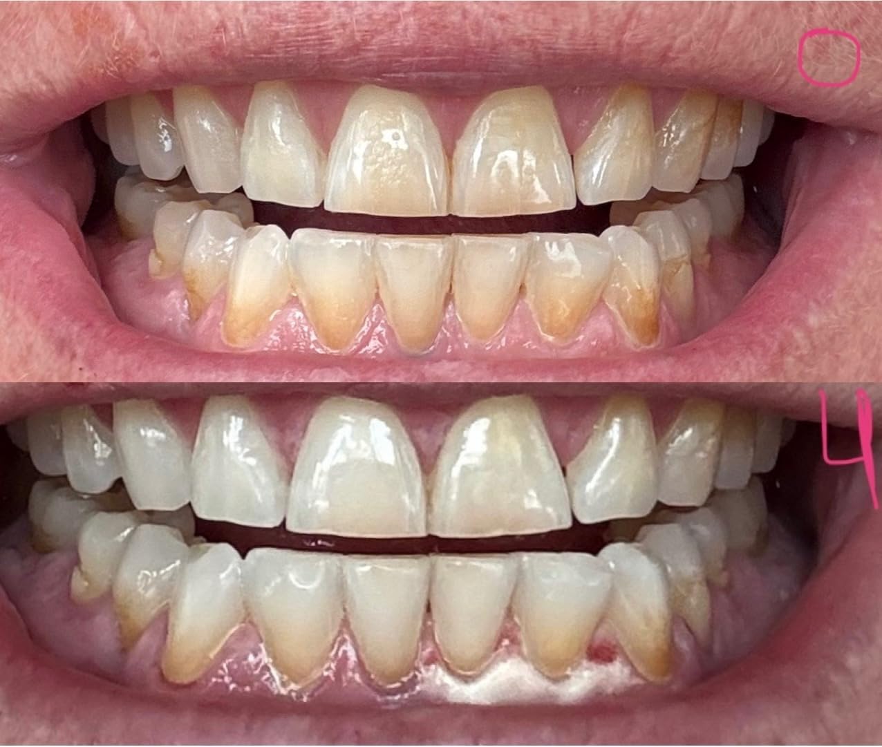 Auraglow 44% Teeth Whitening Gel for Trays, Retainers & Aligners - Dentist Strength Carbamide Peroxide Whitener, 30 Treatments customer photo 2