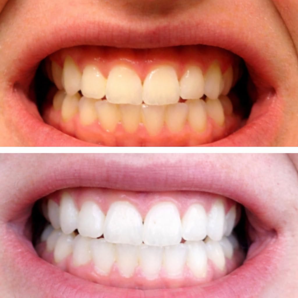 Moldable Teeth Whitening Trays for Gel Customizable Dental Mouth Guards - Compatible with Opalescence and All Gels - 4 Trays & 2 Storage Cases customer photo 1