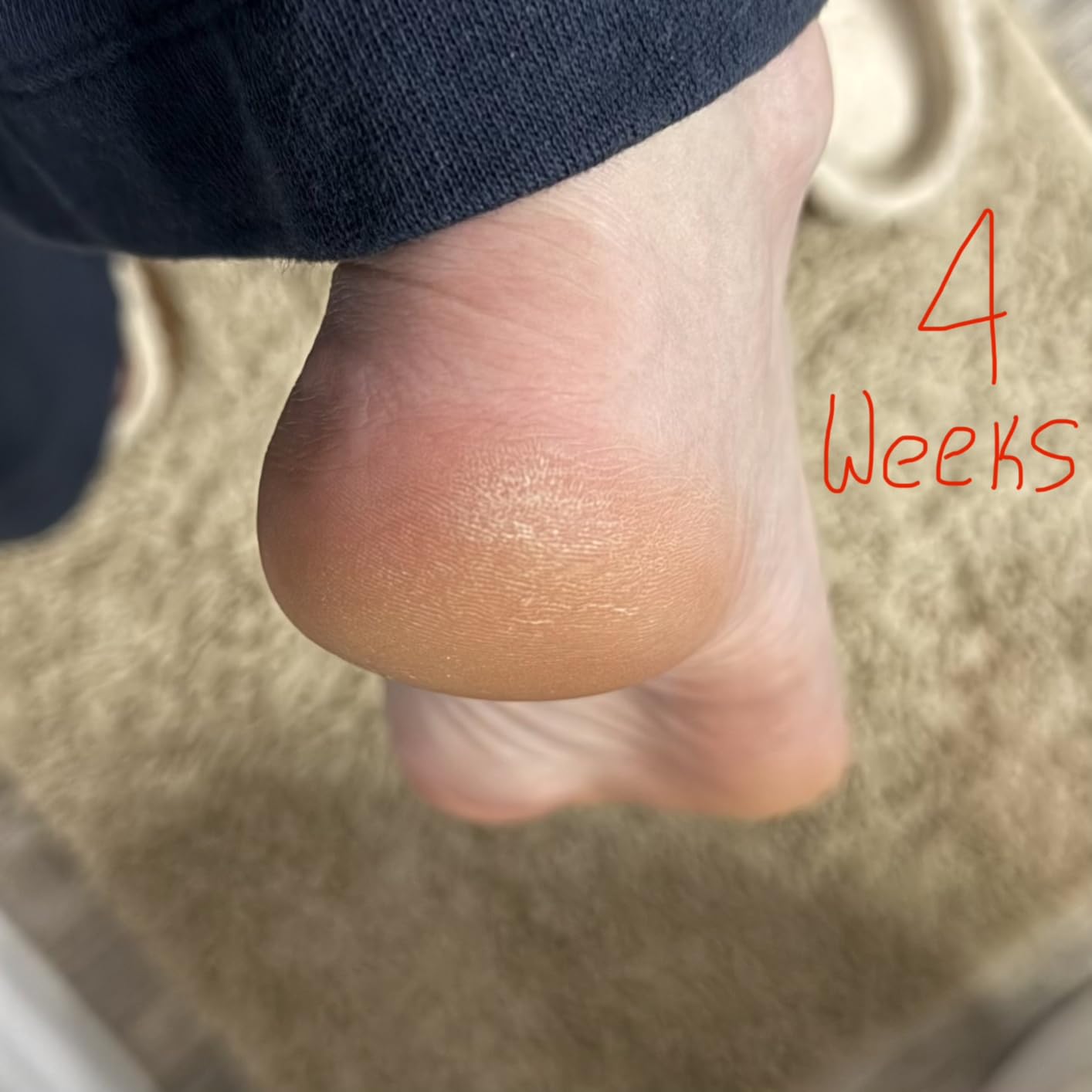O'Keeffe's for Healthy Feet Intense Renewal Cream with Urea & Alpha Hydroxy Acid - 3 oz Tube (1 Pack) - Chemically Exfoliates and Softens Extremely Callused, Dry Feet customer photo 1