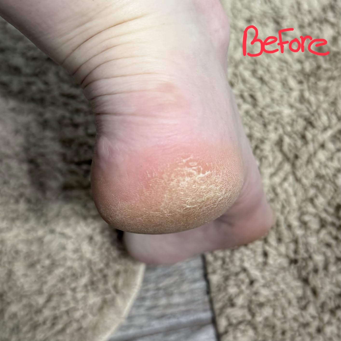 O'Keeffe's for Healthy Feet Intense Renewal Cream with Urea & Alpha Hydroxy Acid - 3 oz Tube (1 Pack) - Chemically Exfoliates and Softens Extremely Callused, Dry Feet customer photo 2