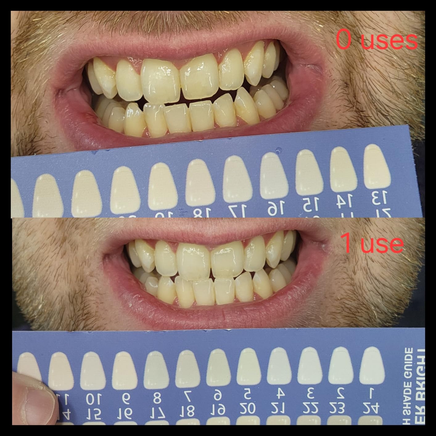 iSmile Teeth Whitening Kit - LED Light, 35% Carbamide Peroxide, (3) 3ml Gel Syringes, (1) Remineralization Gel, and Tray. customer photo 2