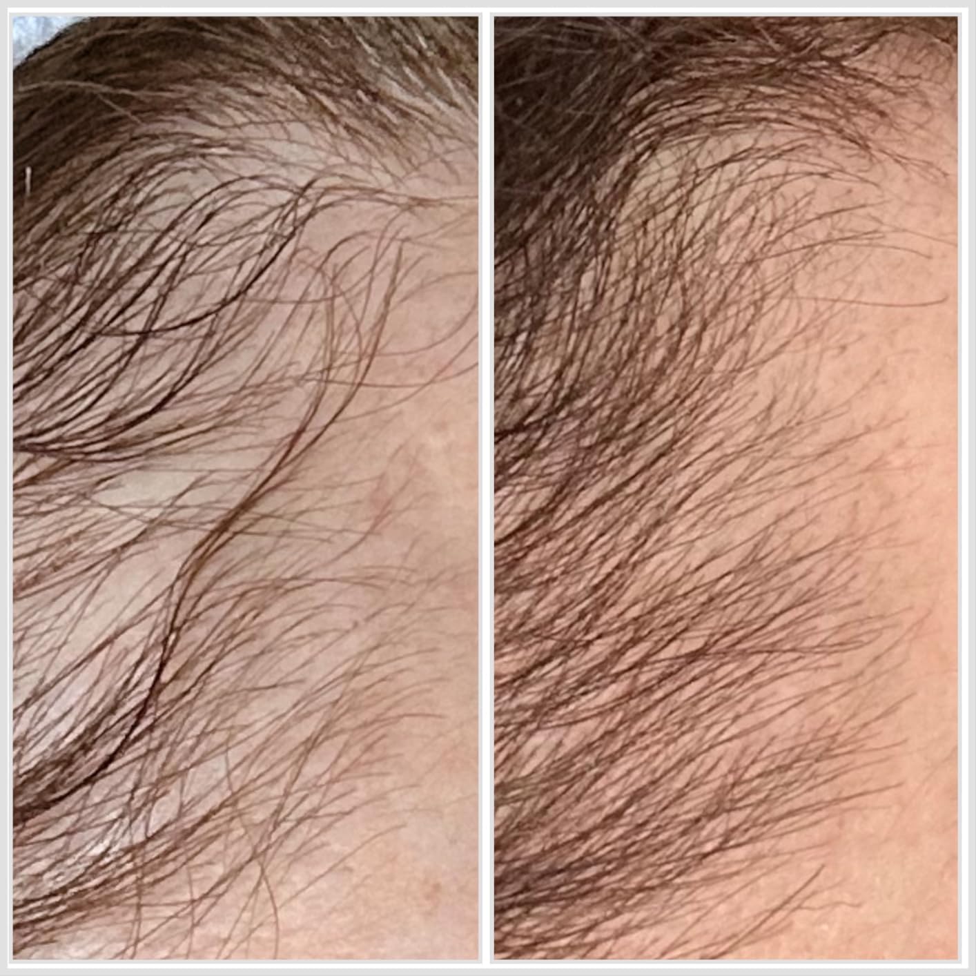 Hairmax LaserBand 82 - Hair Growth and Regrowth Treatment - Restores Natural Hair Cycle - Home-Use Medical Device With Medical Grade Lasers customer photo 2