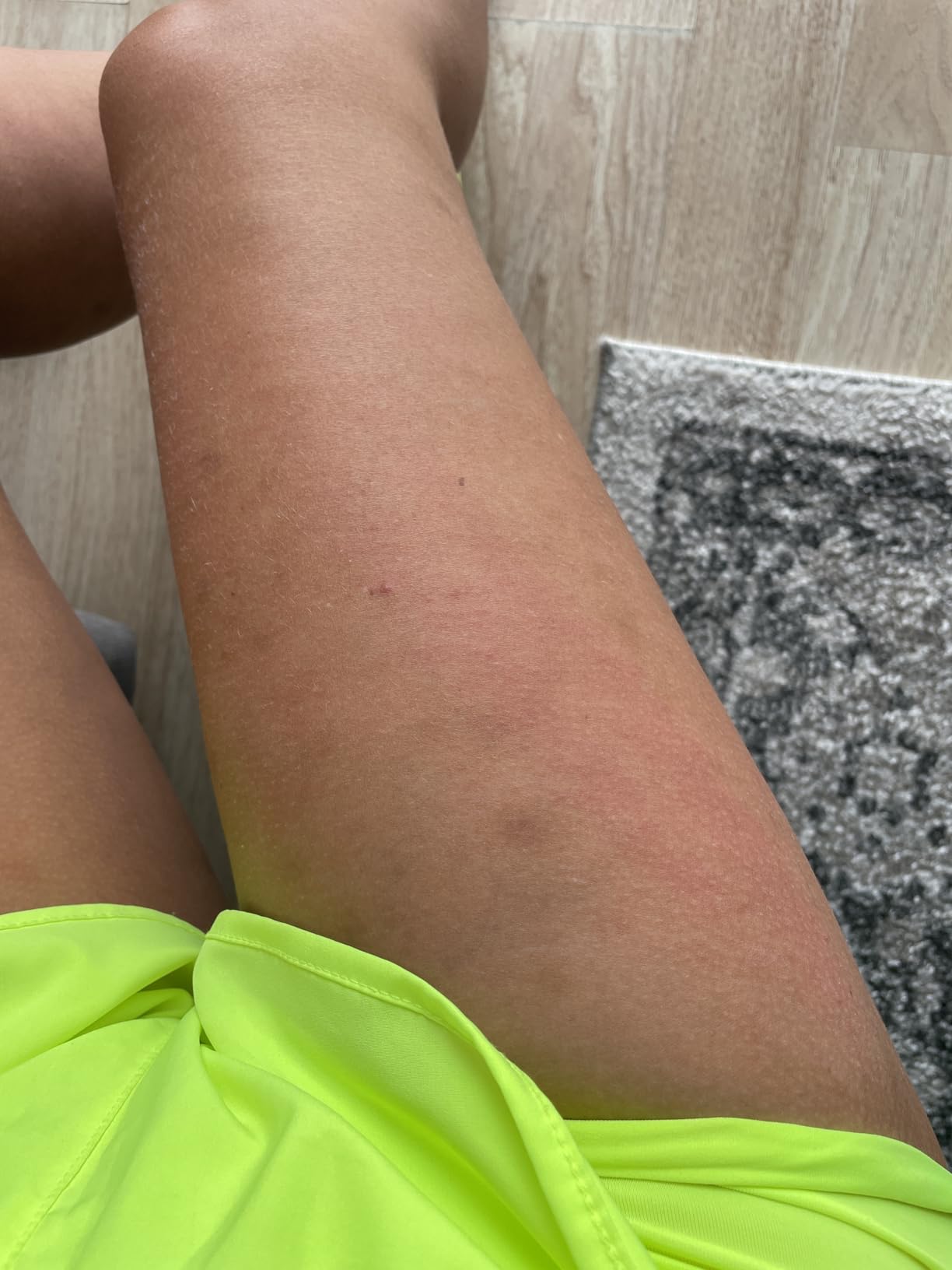 TESMED Cellulite Manual Massager : Made in Italy, Patented with Converging & Diverging Roller Technology. Anti Cellulite Roller for Thighs and Buttock customer photo 1