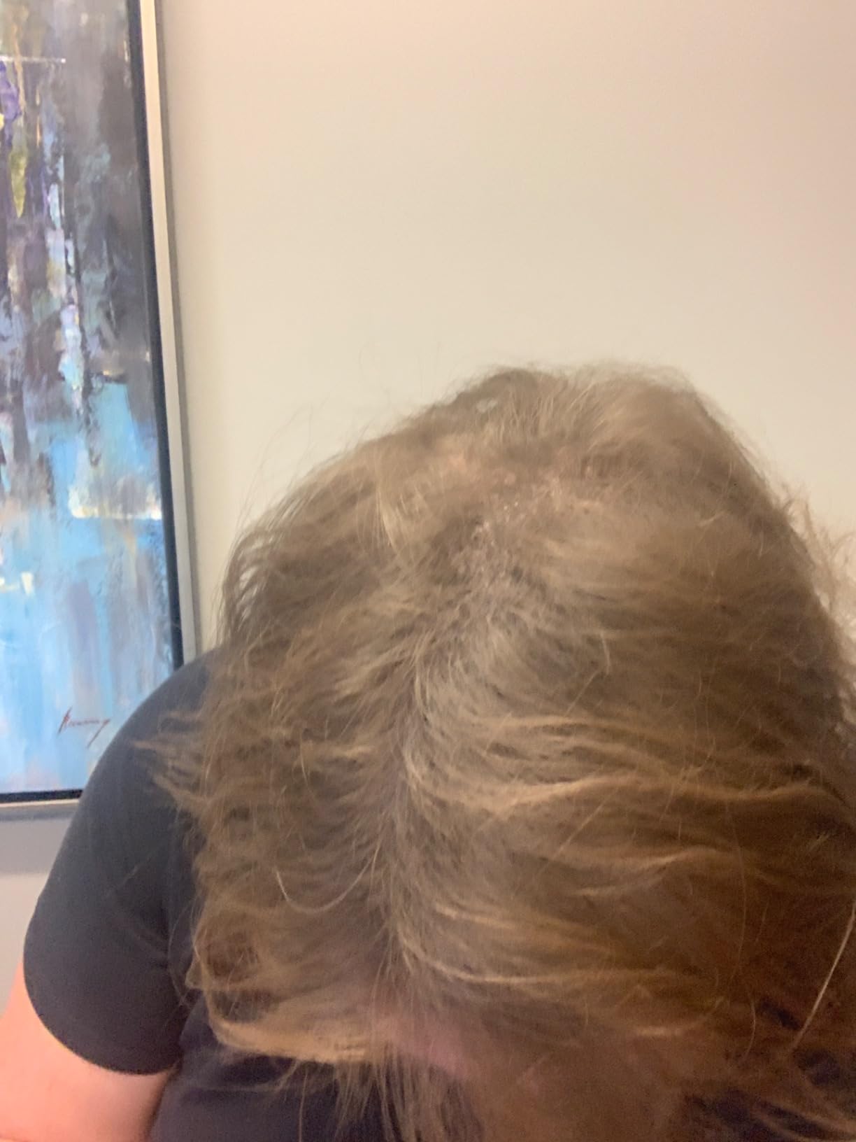Hair Fibers for Thinning Hair (DARK BROWN) Undetectable & Natural - Giant 28g Bottle - Hair Thickener + Instant Thicker Fuller Hair - Completely Conceals Hair Loss in 15 Seconds for Women & Men customer photo 2