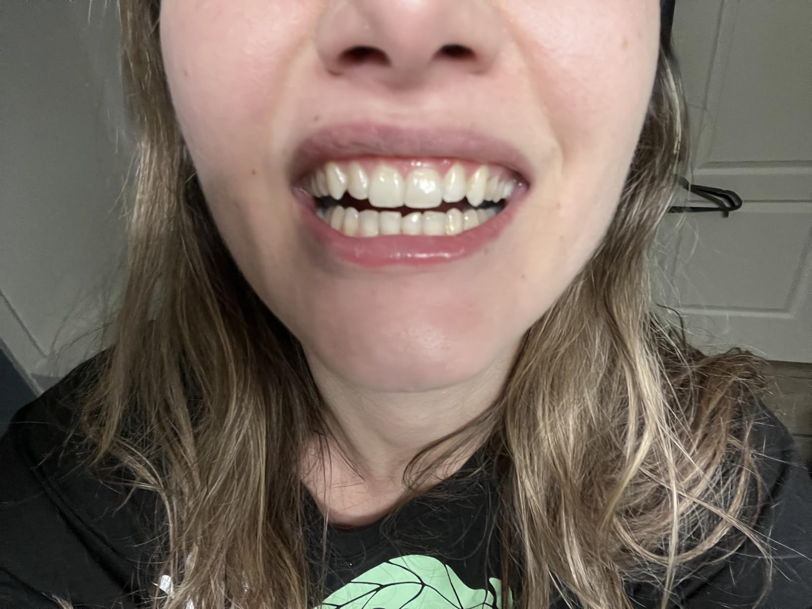 Burst Sensitive Teeth Whitening Strips (Mint) | 20 Strips/10 Treatments - Each with 1 Upper/1 Lower | Visible Results in 15 Minutes | No-Slip Grip | Enamel-Safe Whitening Kit customer photo 2