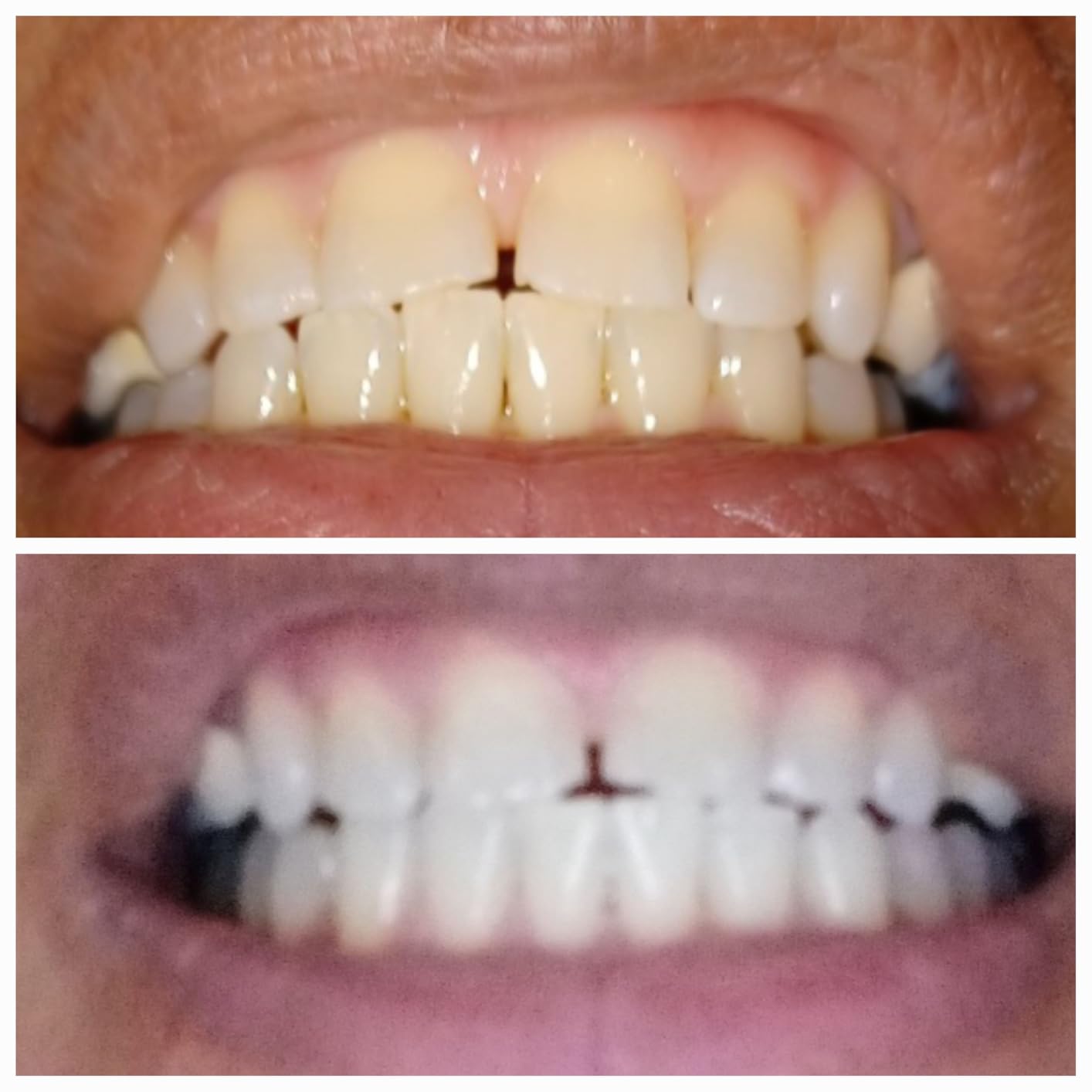 MySmile Teeth Whitening Accelerator Light, 28 LED Blue Light, Mouth Trays, 1 Pcs LED Light & 4ml Gel customer photo 2