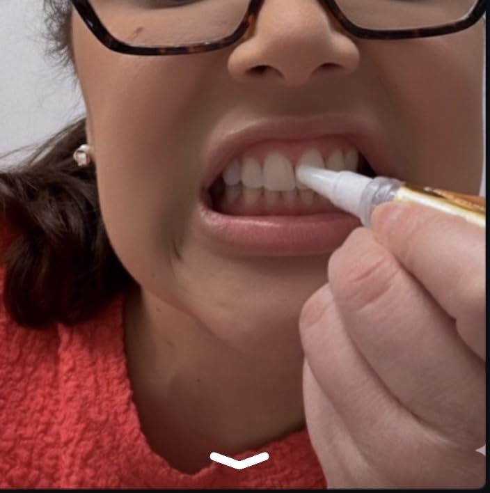 Auraglow Teeth Whitening Pen - Extra Strength 9% Hydrogen Peroxide, 40+ Treatments, No Sensitivity, Removes Coffee Wine Tea Stains, Whiten Teeth Fast, Enamel Safe, Made in USA, 4mL customer photo 1