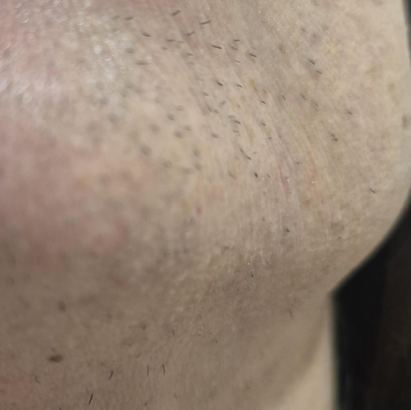Braun Smart IPL Skin iExpert Pro 7 IPL7387 customer photo 2
