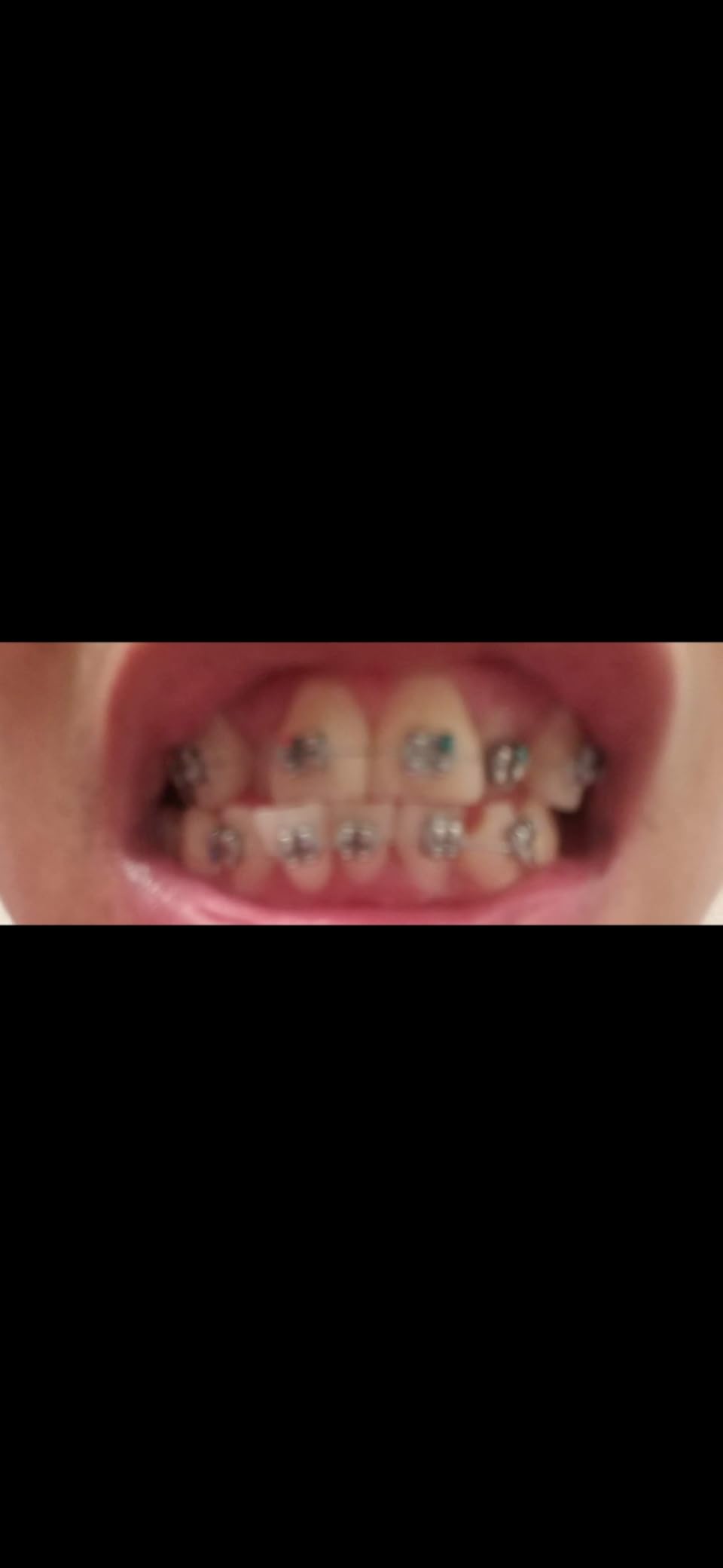 Crest 3D Whitestrips Sensitive & Gentle + LED Light - Teeth Whitening Kit, 1 Light + 14 Treatments, Each with 1 Upper/1Lower, 28 Strips - Crest 3DWhite Teeth Whitening Strips customer photo 2