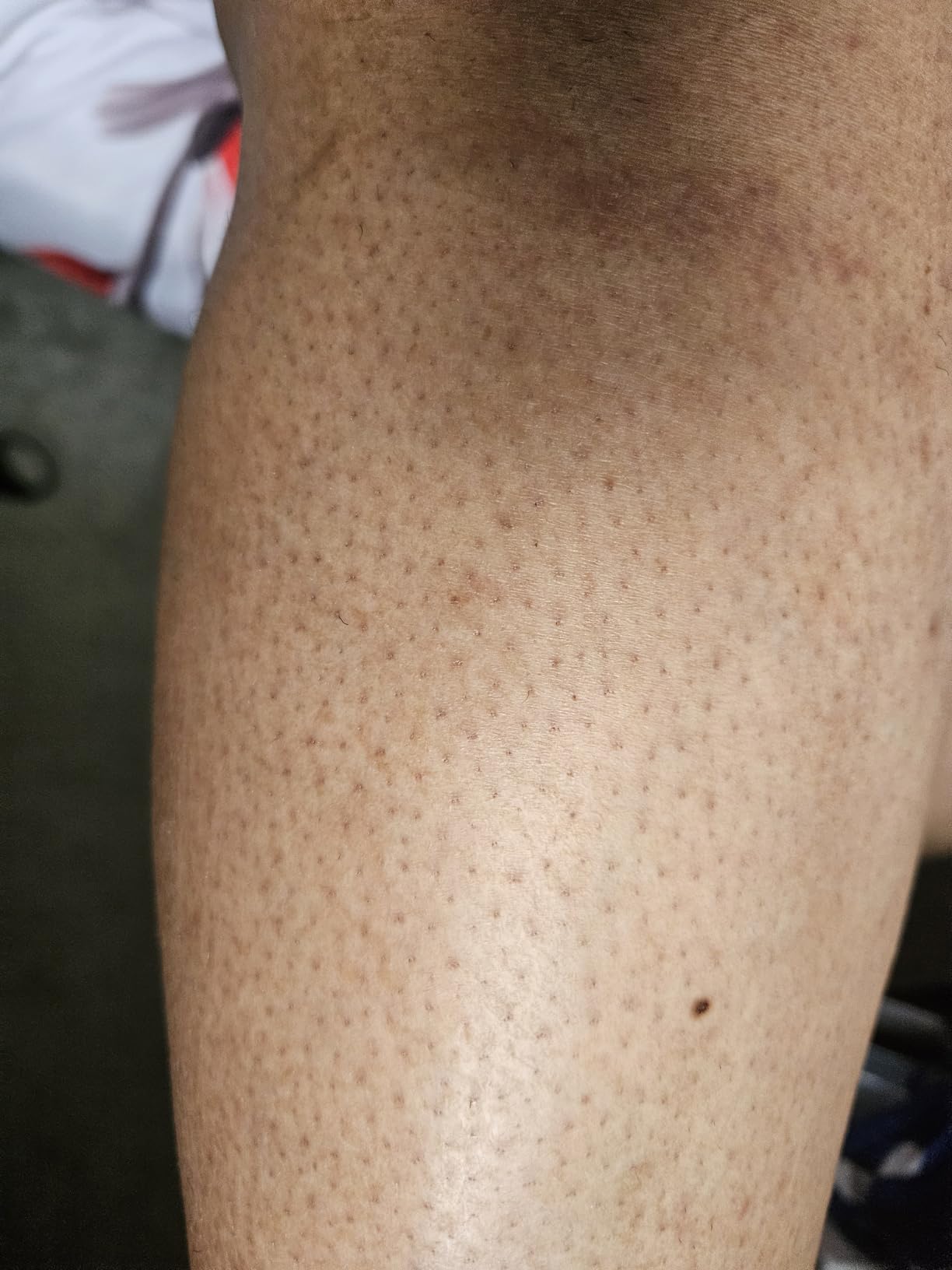 Ulike Air 10 IPL Laser Hair Removal customer photo 1