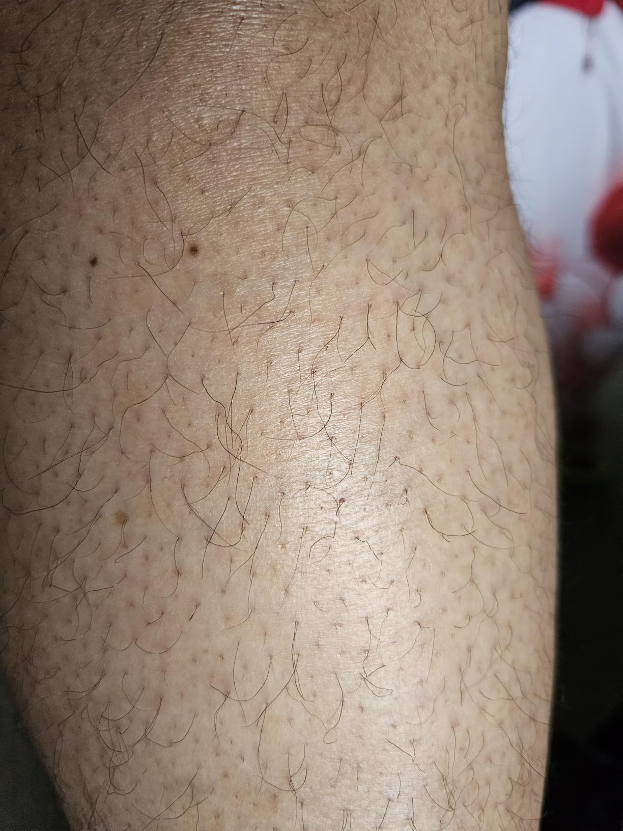 Ulike Air 10 IPL Laser Hair Removal customer photo 2