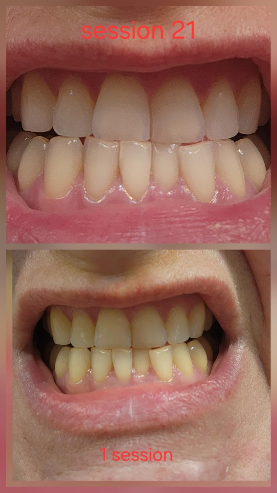 Snow Teeth Whitening Kit - Snow Teeth Whitening Serum and LED Mouthpiece Whitener, Formulated with Hydroxyapatite, Good for 2 Months - Wired Kit with 1 Wand customer photo 1