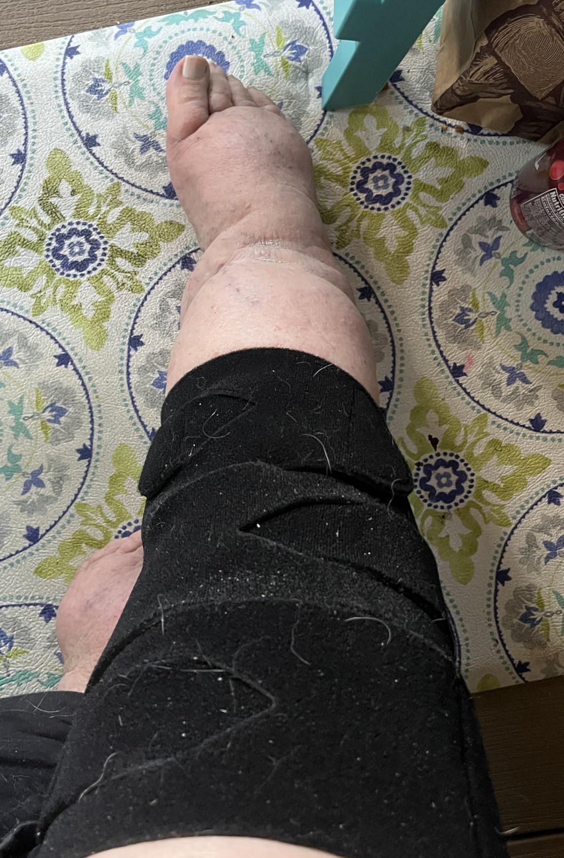 iDonua® Calf Lymphedema Compression Wrap Adjustable For Big Swollen Lower Leg - with 6 Cross Straps (Tall-L) customer photo 1