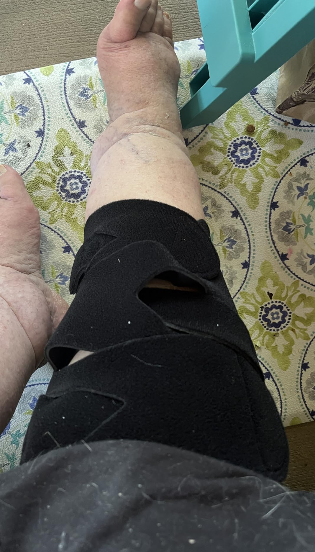 iDonua® Calf Lymphedema Compression Wrap Adjustable For Big Swollen Lower Leg - with 6 Cross Straps (Tall-L) customer photo 2
