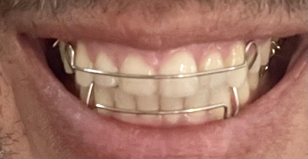 2 Custom Hawley Retainers for Teeth Retention - Comfortable & Durable Upper & Lower Retainers, Personalized Fit customer photo 1