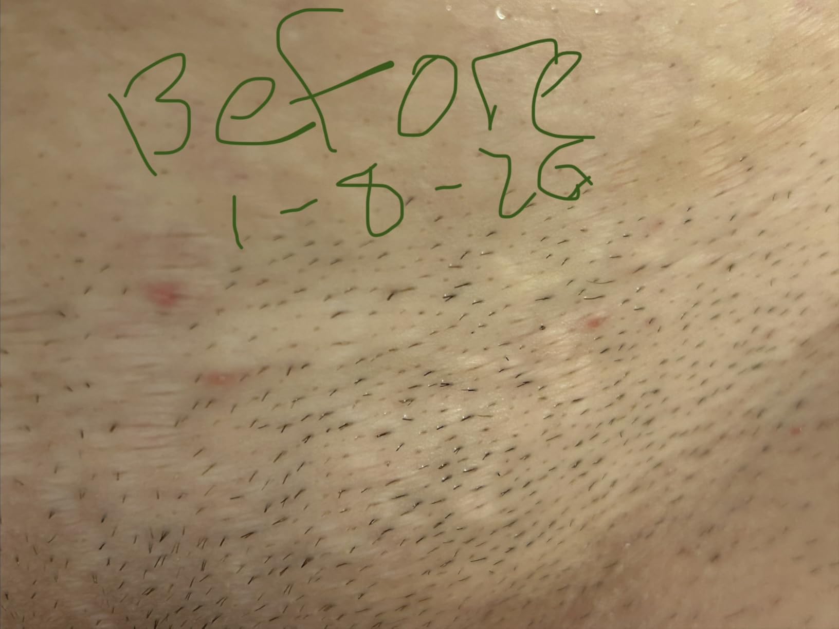 RoseSkinCo Lumi IPL Laser Hair Removal customer photo 1