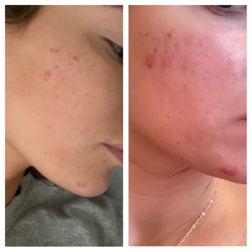 TUMAKOU Portable High Frequency Facial Machine - Orange High Frequency Face Skin Wand Device customer photo 2