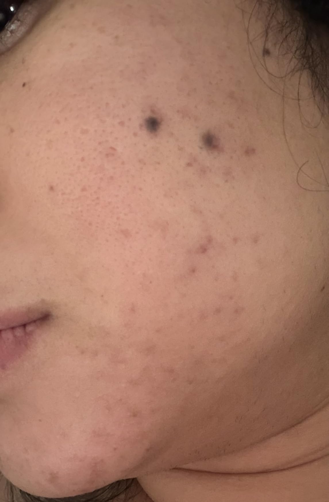 CeraVe Resurfacing Retinol Serum For Post Acne Marks, Formulated With Licorice Root Extract & Niacinamide, Brightening Serum & Pore Minimizer For Face, Post Acne Skin Barrier Repair, Non-Comedogenic customer photo 1