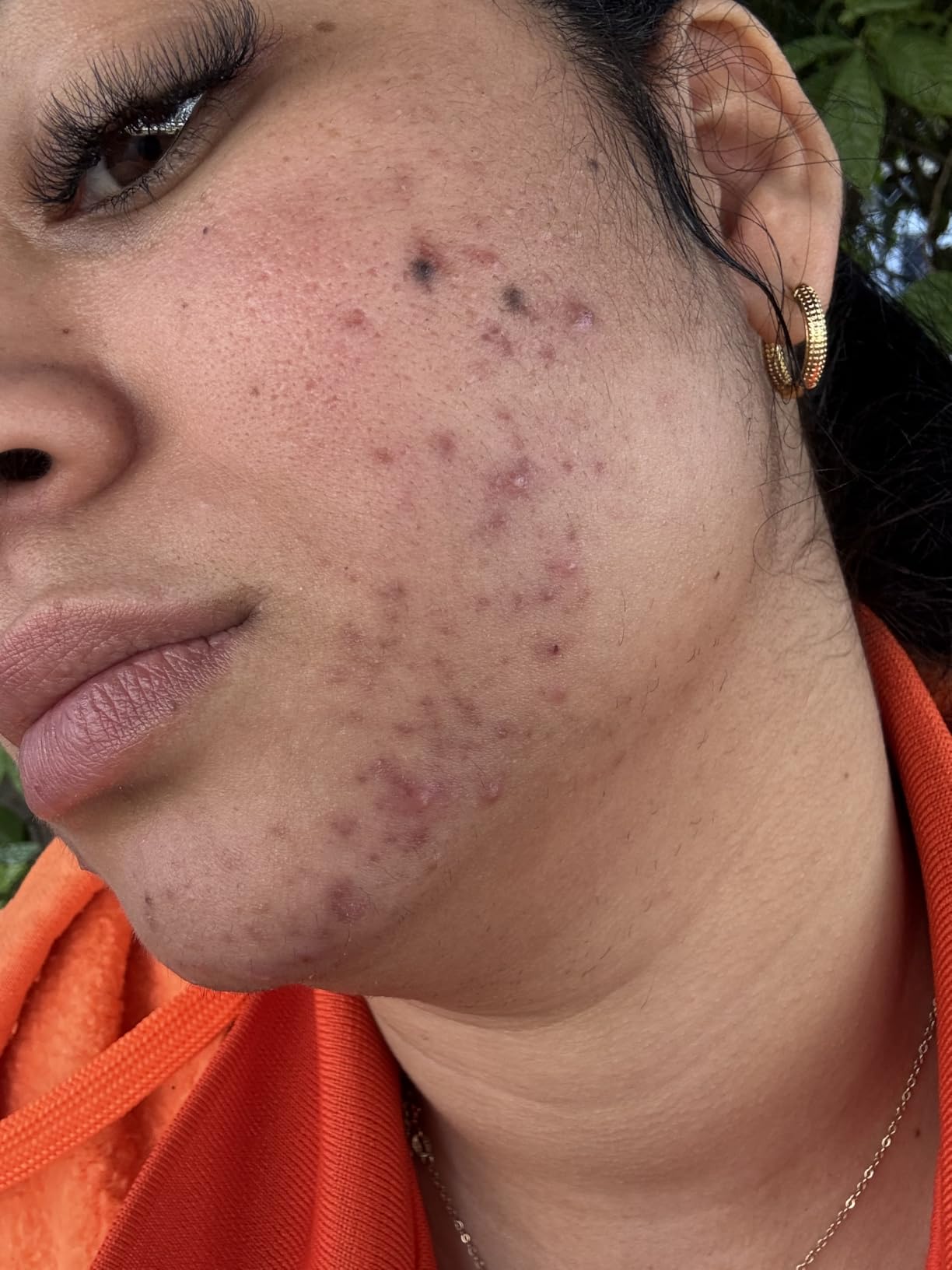 CeraVe Resurfacing Retinol Serum For Post Acne Marks, Formulated With Licorice Root Extract & Niacinamide, Brightening Serum & Pore Minimizer For Face, Post Acne Skin Barrier Repair, Non-Comedogenic customer photo 2