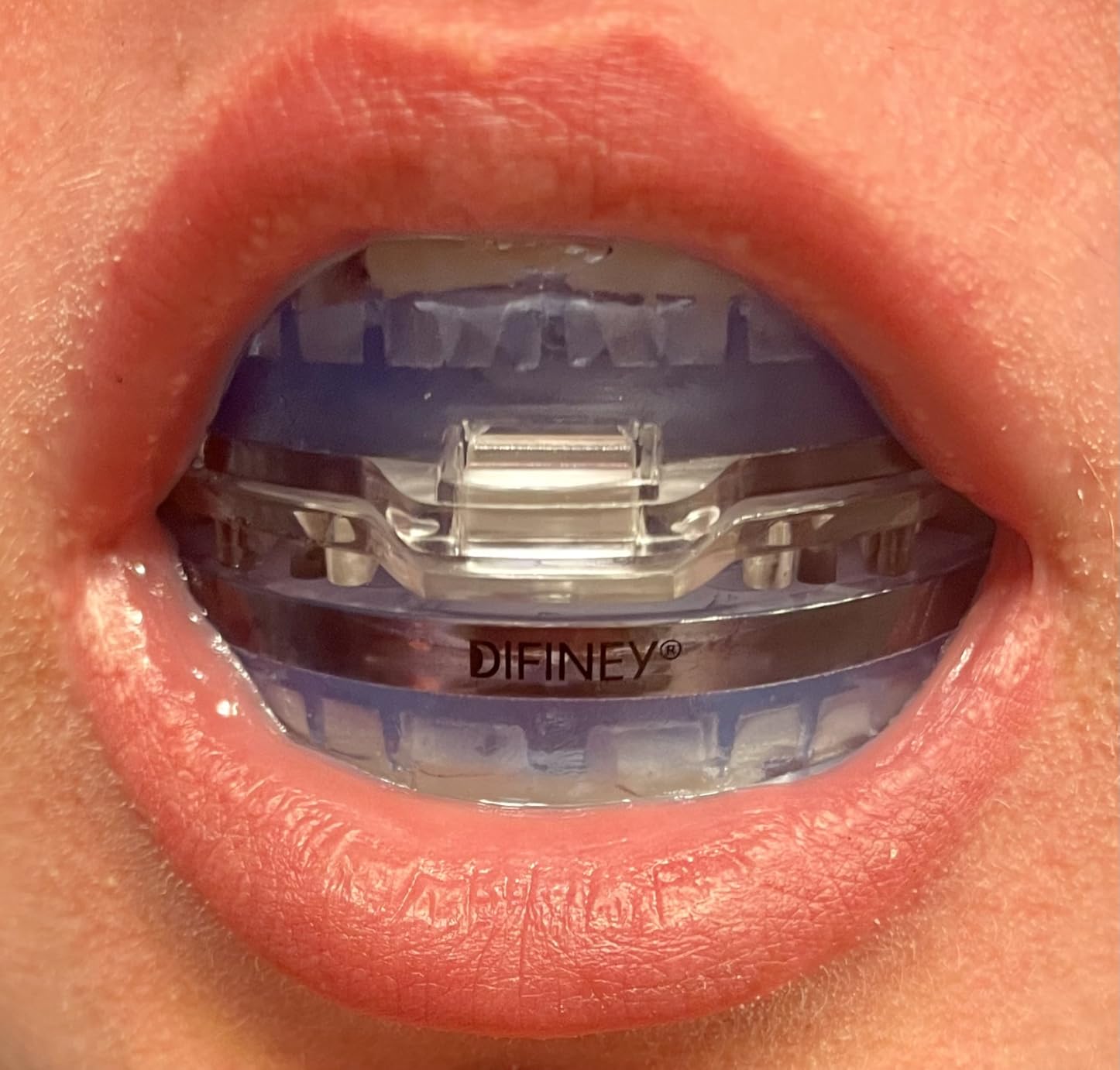 Difiney Anti Snoring Device: FDA-Cleared Anti Snoring Mouthpiece - Adjustable Snore Stopper Mouth Guard for Men & Women to Sleep Better - Reusable Nighttime Use with Storage Case customer photo 1